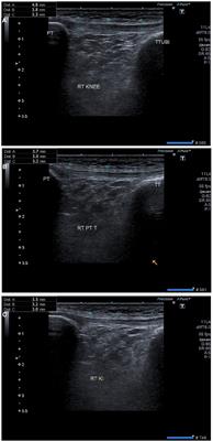 Efficacy of ultrasound guided dry needling as an adjunct to conventional physical therapy for patients with jumper’s knee: A randomized controlled trial